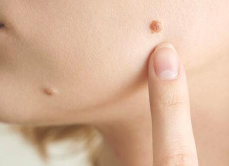 Почему появляются бородавки на лице, и как их вылечить?