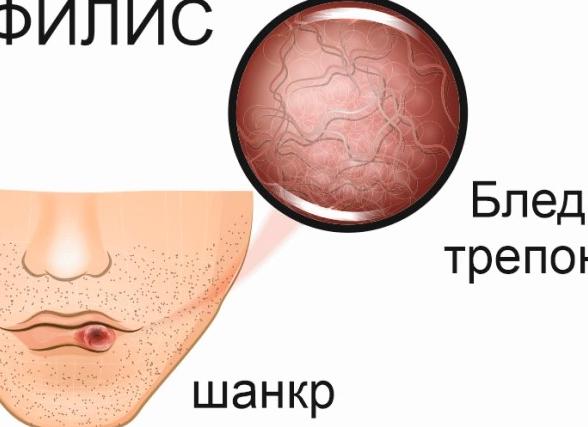 Пути инфицирования бледной трепонемой, симптомы заражения, лечение