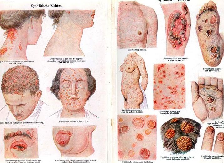 Возможные осложнения и последствия сифилиса