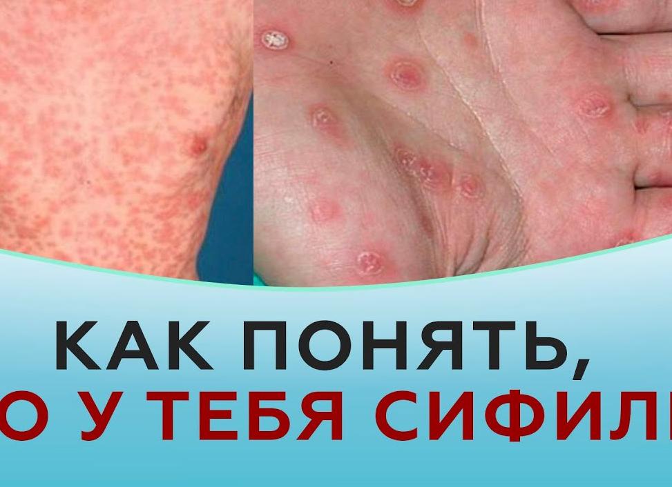 Как распознать сифилис на первых этапах?
