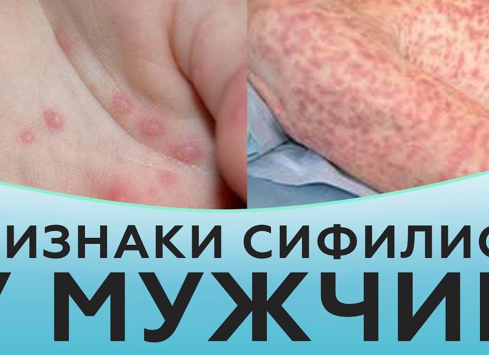 Первые симптомы сифилиса, как распознать болезнь?