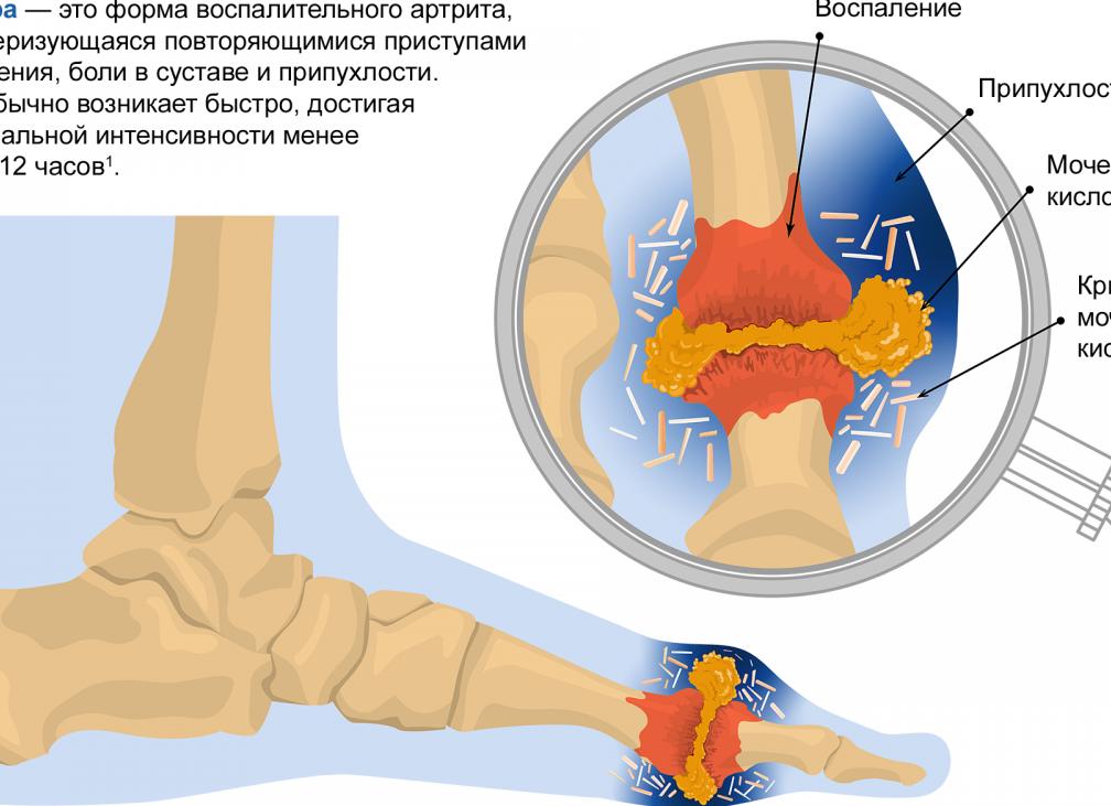 Что такое гиперурикемия, почему образуется, и как её лечить?