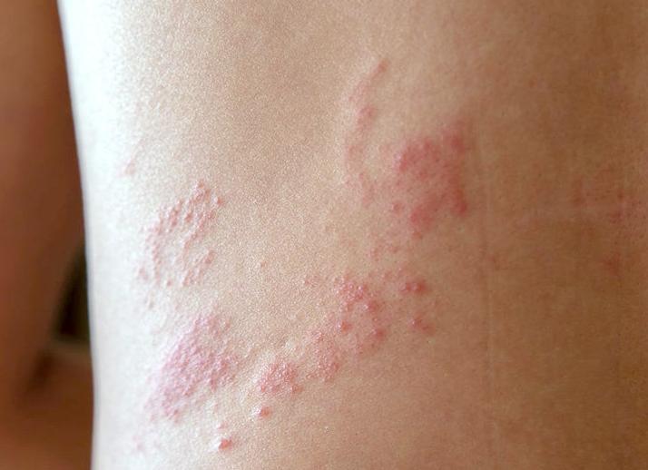 Проявление и лечение герпеса на ноге