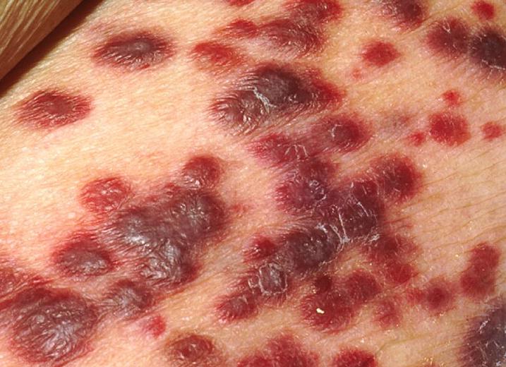 Что такое герпес 8 типа и в чем его опасность