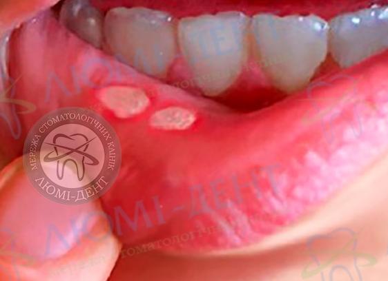 Как лечить герпес на внутренней стороне губы?