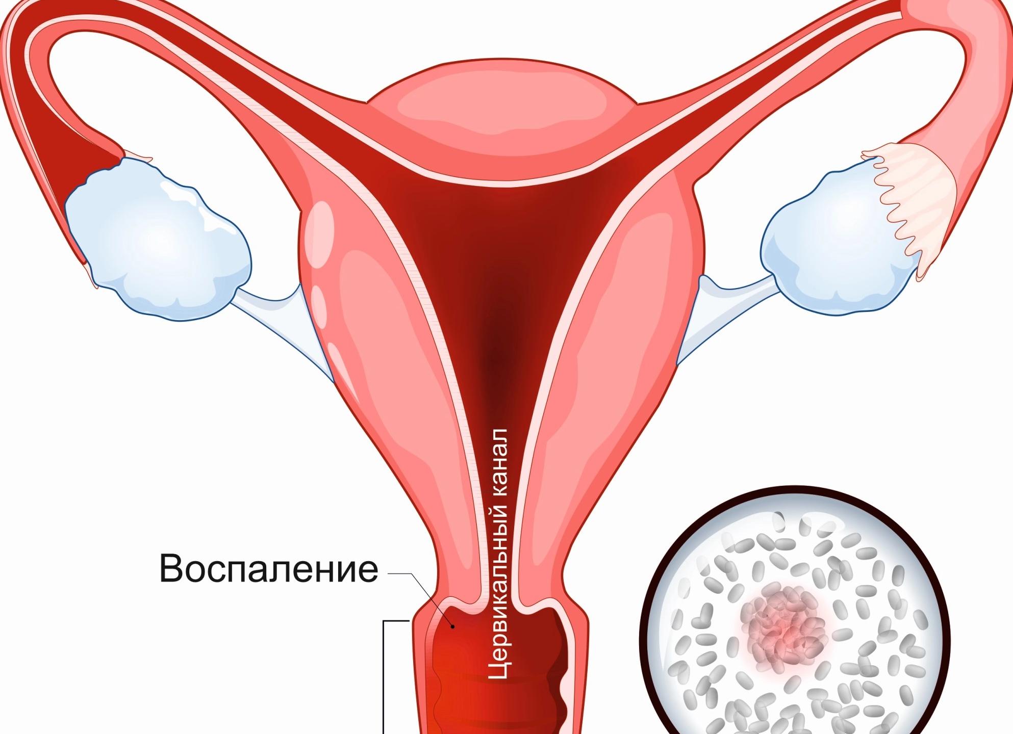 Что такое Гарднерелла Вагиналис, что делать если обнаружили её ДНК в ПЦР?