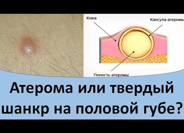 Сифилис на губе — симптомы и лечение