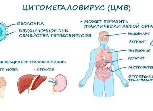 Какие симптомы у цитомегаловирусной инфекции (ЦМВ)