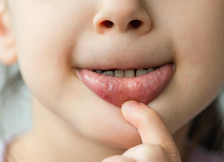 Вирус герпеса 4 типа у детей и взрослых