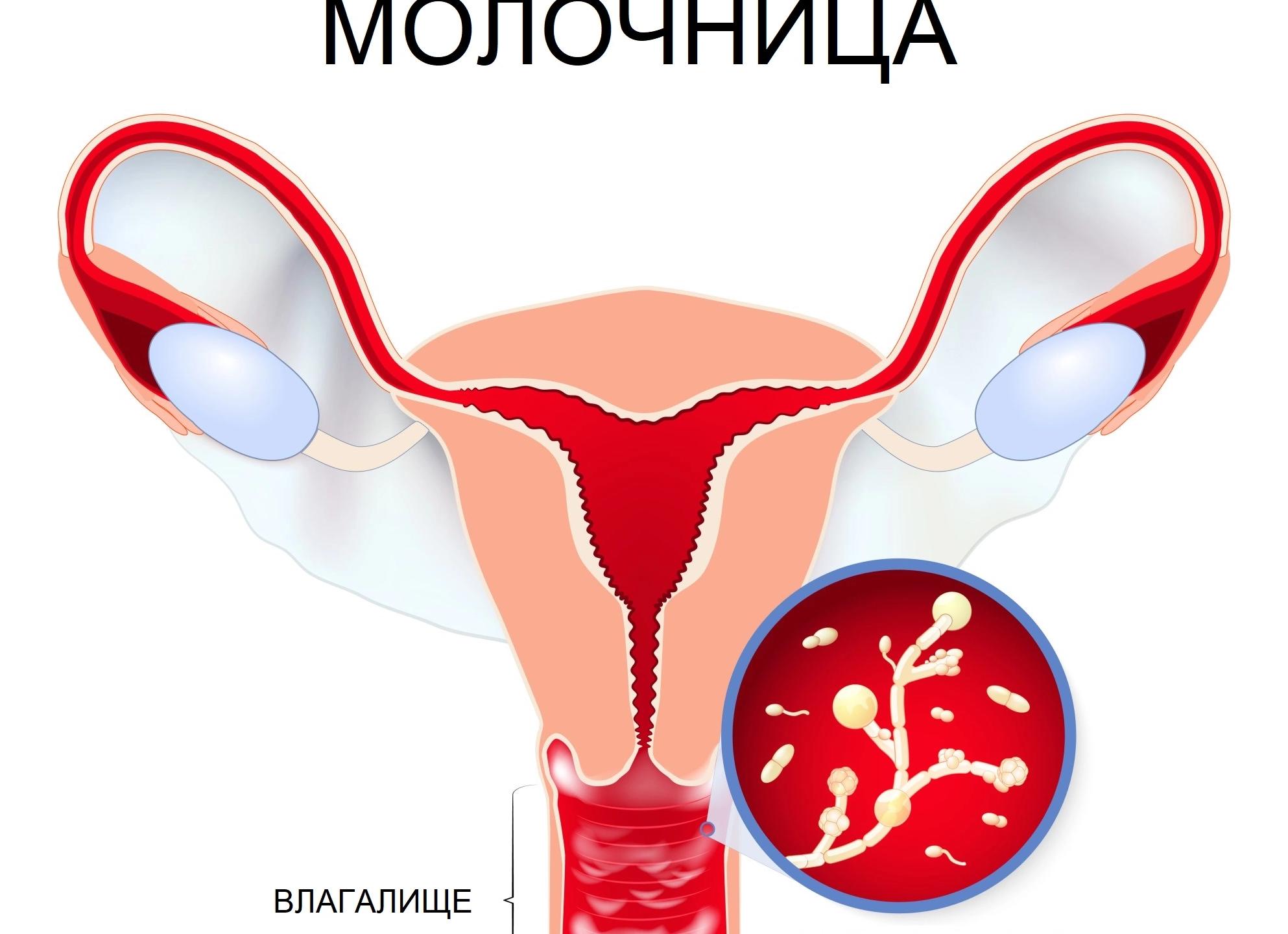 Какими народными средствами можно лечить молочницу у беременных