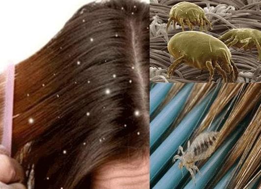 Как быстро вывести вшей дома?