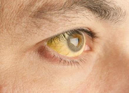 Что означает наличие билирубина в моче, какова его норма, почему он повышается?