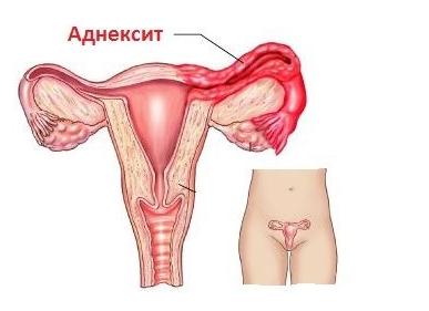 Что делать, если болит внизу живота при молочнице?