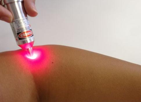 Как можно удалить папиллому с интимного места?