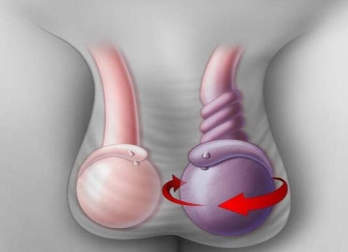Причины появления болей левого яичка у мужчин, способы лечения
