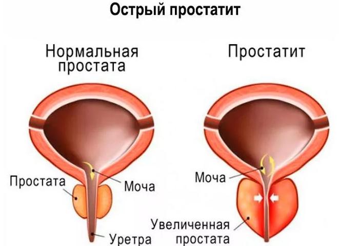 Какие симптомы у воспаления простаты и как их лечить?