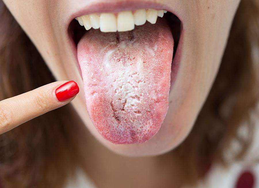 Как выглядит и как лечить молочницу у мужчин