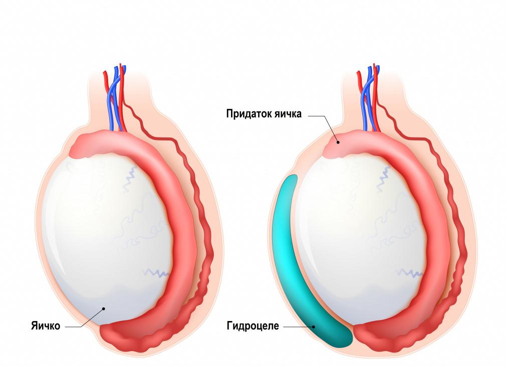Почему развивается водянка яичка у мальчиков, как ее лечить?