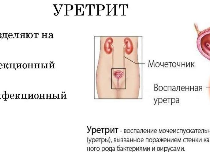 Симптомы и современное лечение уретрита