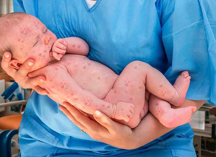 Опасность вируса герпеса во время беременности