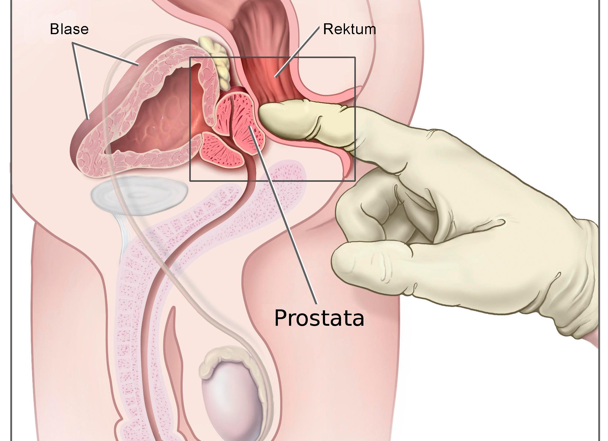 Как выполняется массаж при простатите, и зачем он нужен?