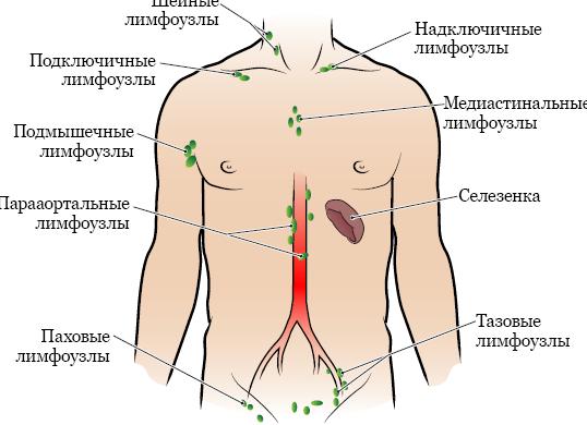 Почему у женщин происходит воспаление лимфоузлов в паху, как это лечить?