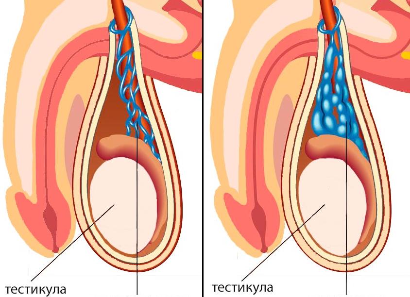 Почему у мужчин появляется варикоцеле, как его лечить?