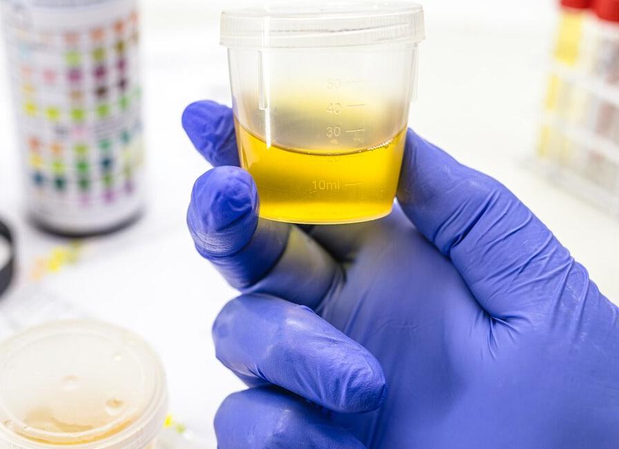 Что означает появление в моче аморфных фосфатов?