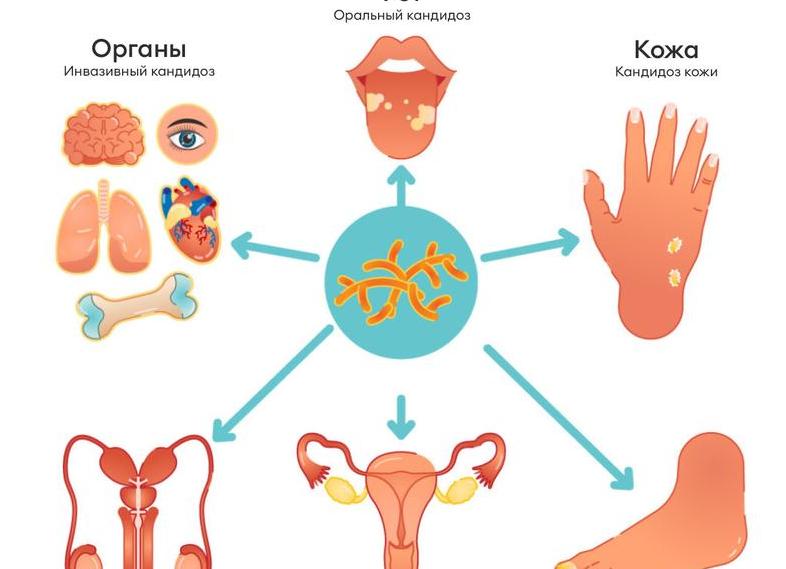 Молочница — что это такое?