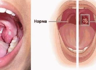 Какие симптомы и как лечить хронический простатит у мужчин?