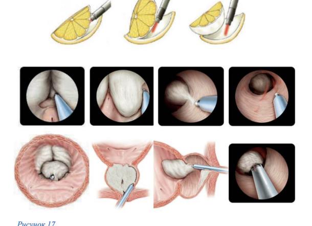 Какие препараты применяют в лечении аденомы простаты и простатита?