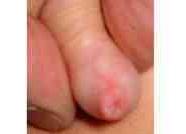 Почему появляется фимоз у мальчиков, что это такое, как его лечить?