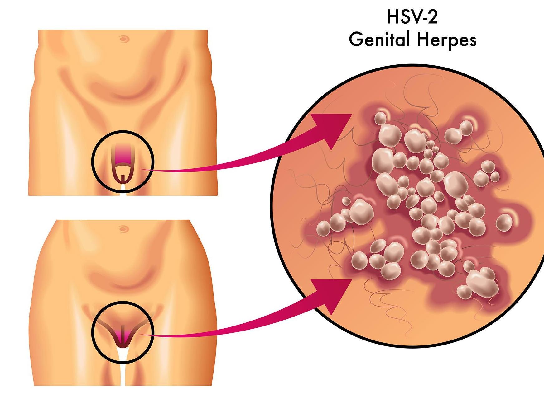 Что такое генитальный герпес и как его вылечить?