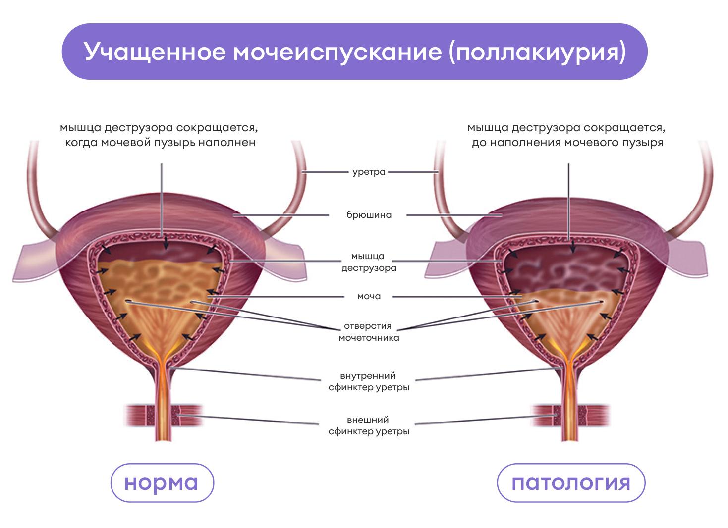 Почему у мужчин возникают частые мочеиспускания без боли?
