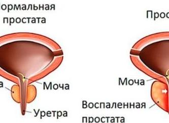 Почему у мужчин могут появляться рези при мочеиспускании, как с ними бороться?